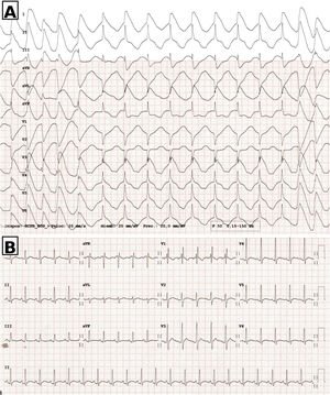 Graphical Abstract Signo del casco prusiano en el electrocardiograma ...