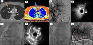 Graphical Abstract Aterectomía rotacional guiada por IVUS para la em...