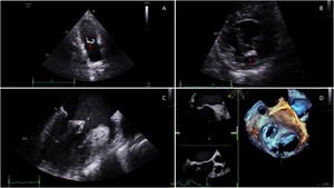 Graphical Abstract Doble orificio mitral aislado como cardiopatía co...
