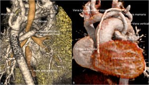 Graphical Abstract Corazón univentricular con drenaje venoso anómal...