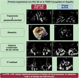 Graphical Abstract Reparación tricuspídea percutánea de borde a bo...