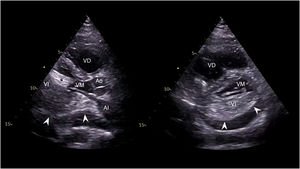 Graphical Abstract Taponamiento cardiaco asociado a DAVI: una imagen ...
