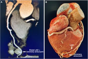 Graphical Abstract Spontaneous resolution of an asymptomatic idiopath...