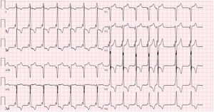 Graphical Abstract Hypertrophic cardiomyopathy in a patient with diab...
