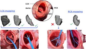 Graphical Abstract Multispline catheter mapping of the coronary ostia...