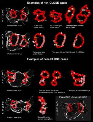 Graphical Abstract Strict intertag distance measurement in atrial fib...