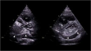 Graphical Abstract LVAD-associated cardiac tamponade: an atypical ech...