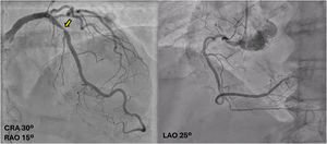 Graphical Abstract Inadvertent false-lumen stenting during iatrogenic...