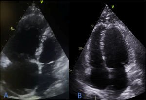 Graphical Abstract Aspiration thrombectomy after failed fibrinolysis ...
